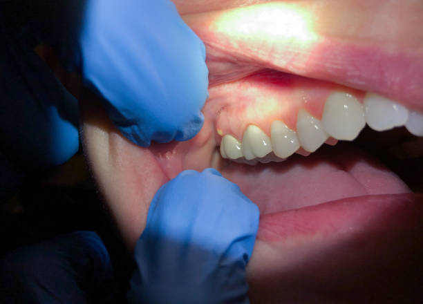 Best Emergency Treatment for Oral Infections in North Webster, IN